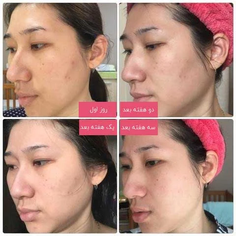 &nbsp;تجربه استفاده از کرم ضد لک؛ نظر کاربران