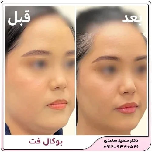 مزایای بوکال فت چیست؟