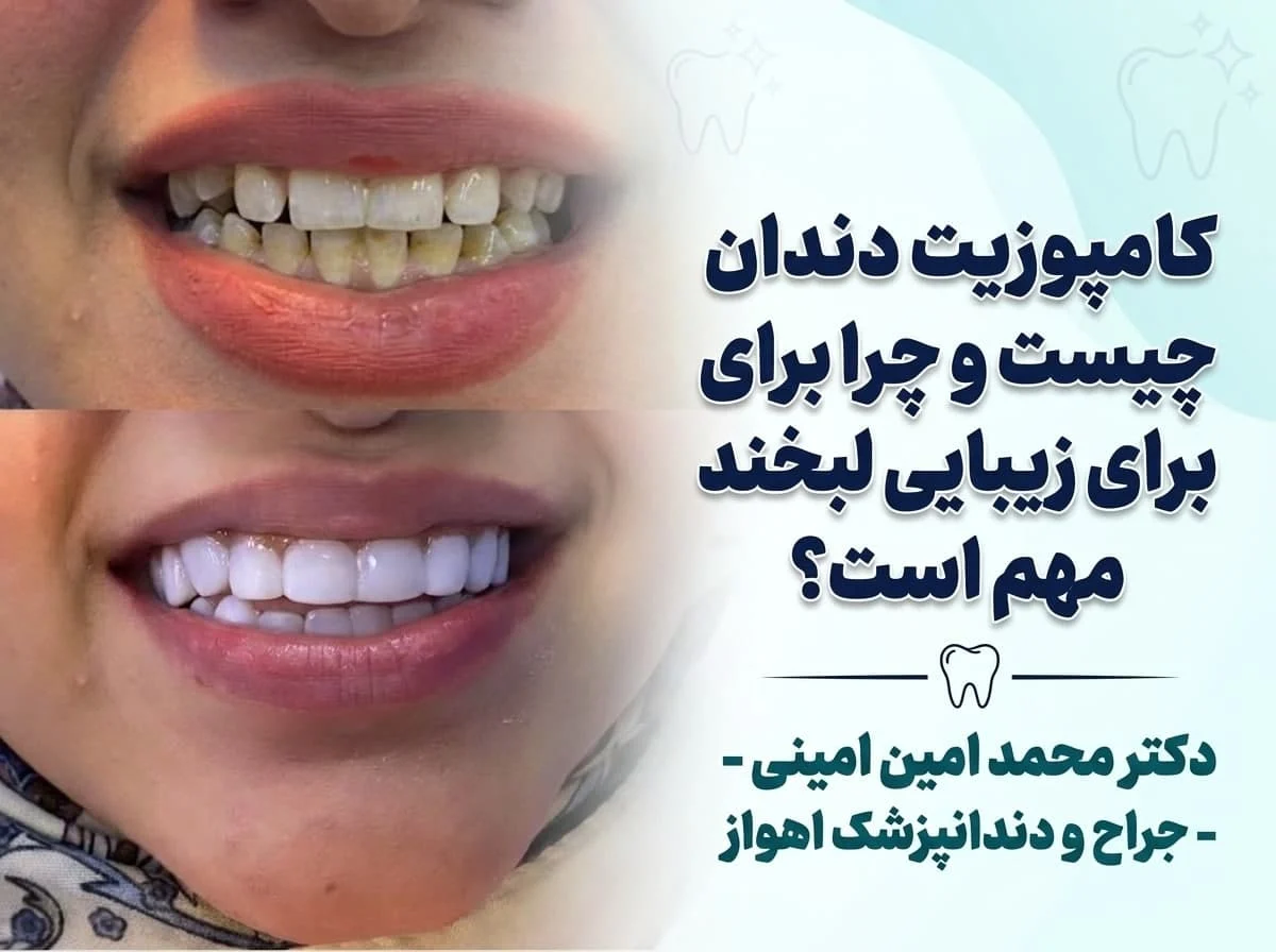 کامپوزیت دندان چیست و چرا برای زیبایی لبخند مهم است؟
