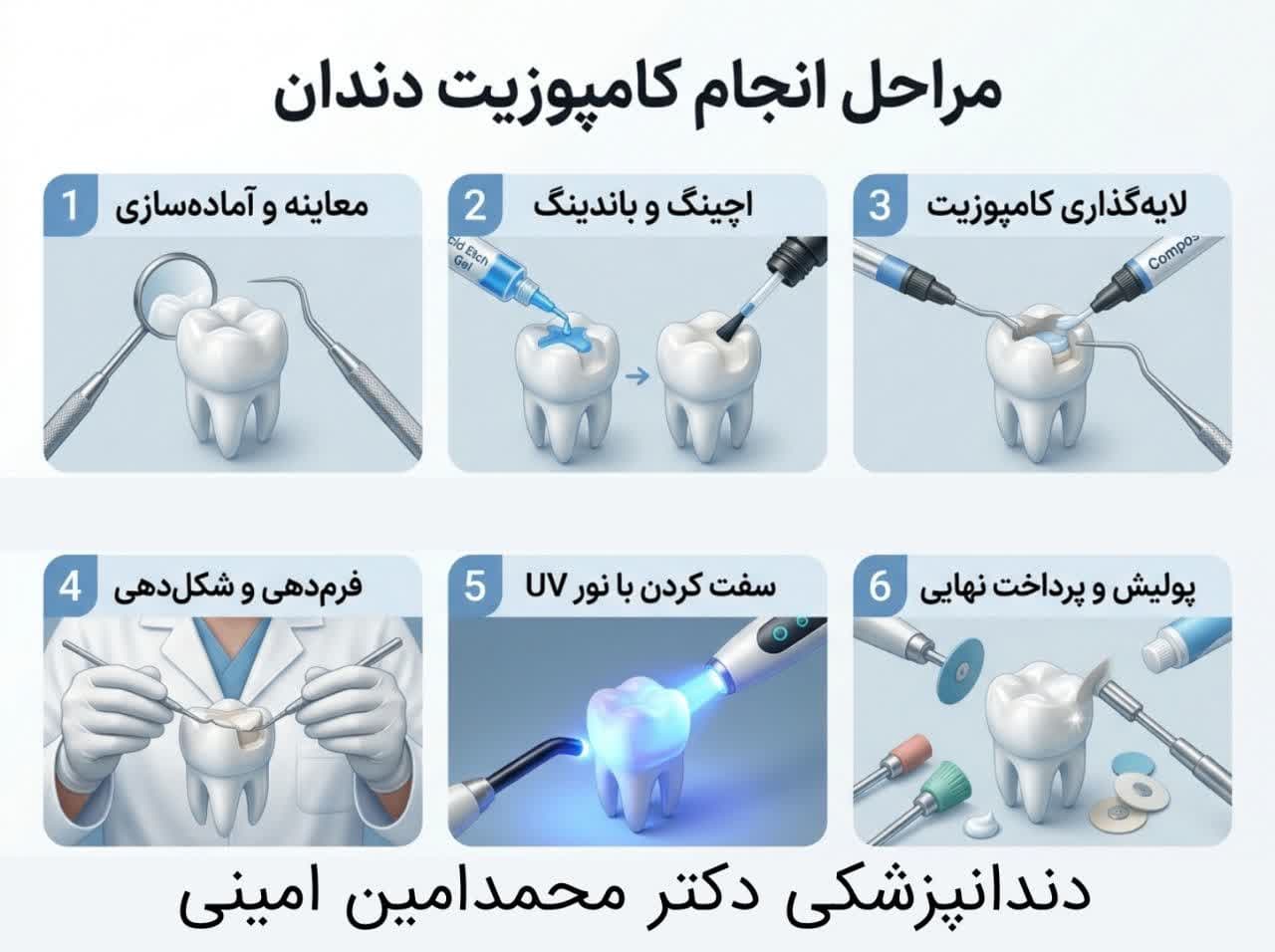 مراحل انجام کامپوزیت دندان دندانپزشکی دکتر امینی